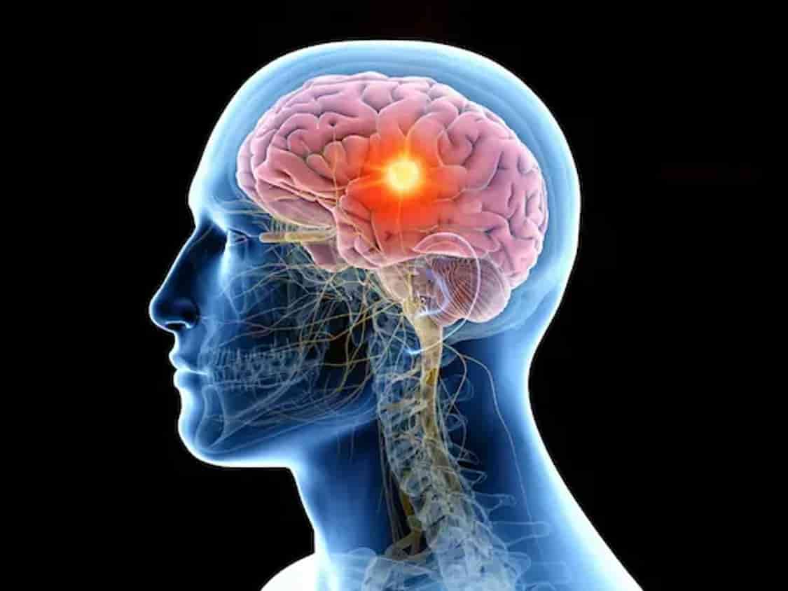 सिरदर्द या ब्रेन ट्यूमर? जानें वो शुरुआती संकेत जिन्हें लोग अक्सर छोड़ देते हैं मामूली थकान समझकर
