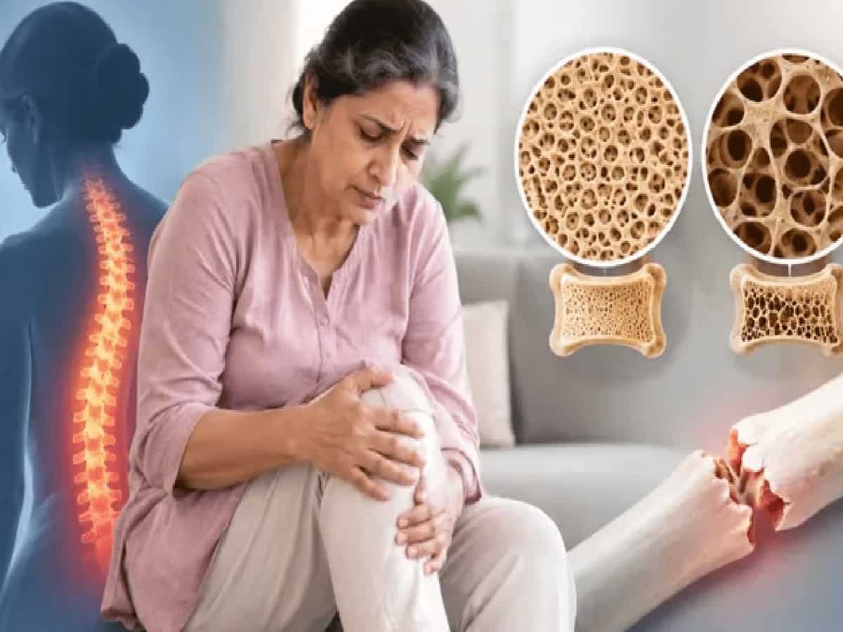 ऑस्टियोपोरोसिस को क्यों कहते हैं 'साइलेंट किलर'? जानें लक्षण, कारण और बचाव के सही उपाय
